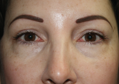 Eyelid Surgery: Patient C