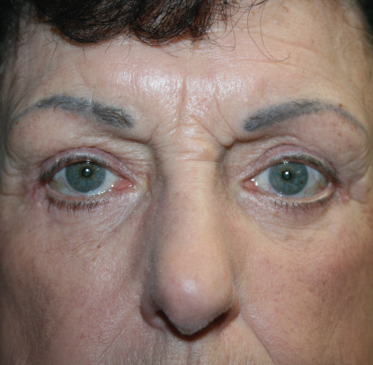 Eyelid Surgery: Patient E