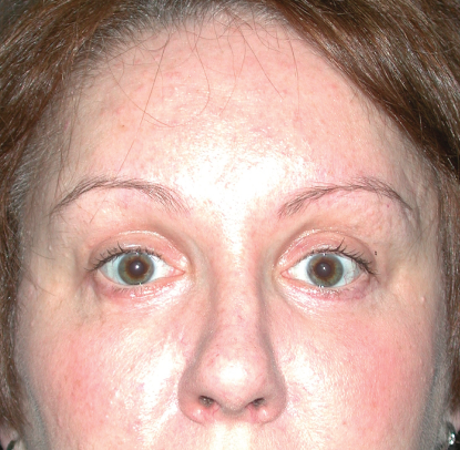 Eyelid Surgery: Patient F