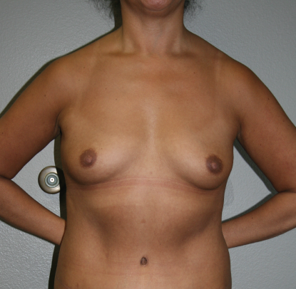 Abdominoplasty: Patient C