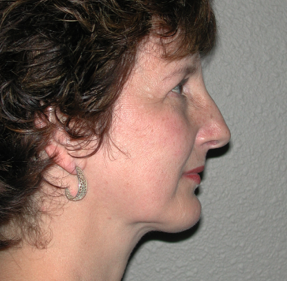 Chin Implant: Patient A