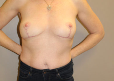 En Bloc and Mastopexy Implant Removal: Patient NG